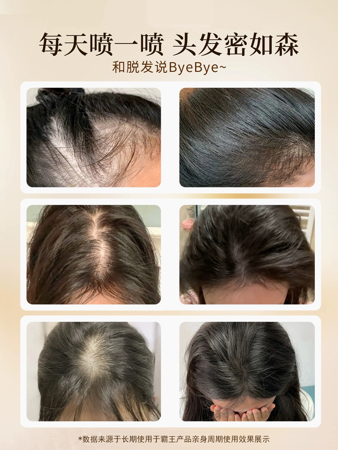 守护发际线的温柔革命 霸王防脱发套装是否值得入手？